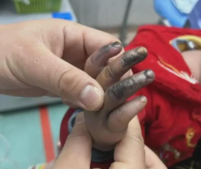 孩子手指瞬间烧黑！电动自行车充电口碰不得→(图1)