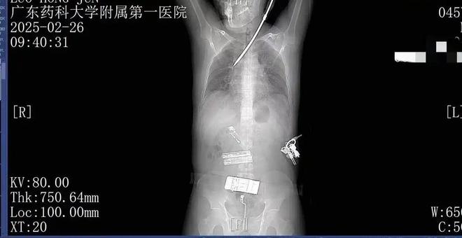 28秒急速救援！广东工地惊险瞬间：螺丝刀从天而降工人胸背重伤(图3)