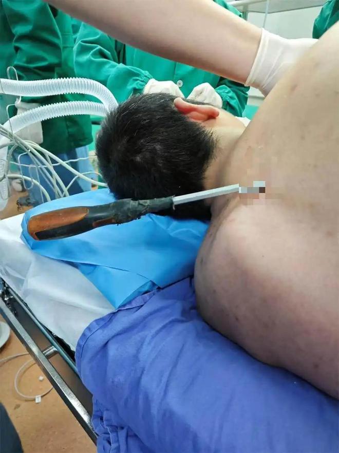 28秒急速救援！广东工地惊险瞬间：螺丝刀从天而降工人胸背重伤(图1)